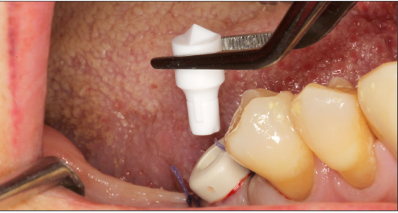 12077_1 Case Report Esthetic Healing Abutment w ScanPeg Dr Zwaan
