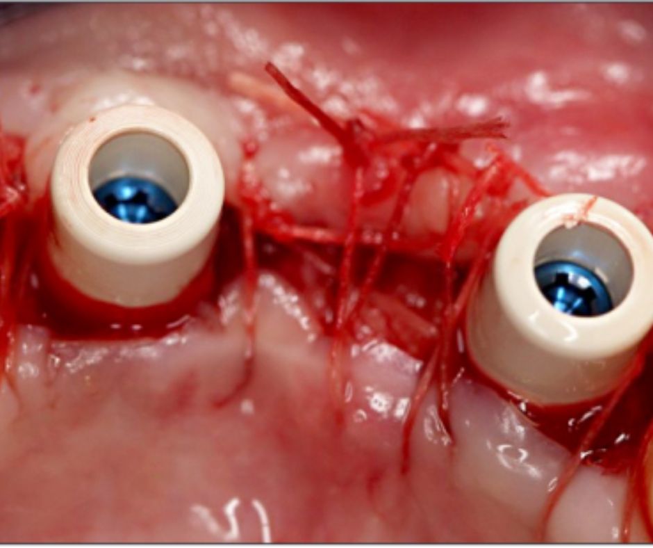 14649_0 Case Report Neoss ProActive 3.25 Dr Uzel