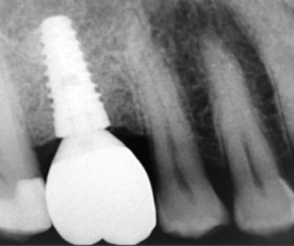 12881_1 Case Report Neoss ProActive Edge Dr Girgis EN letter PRINT INT