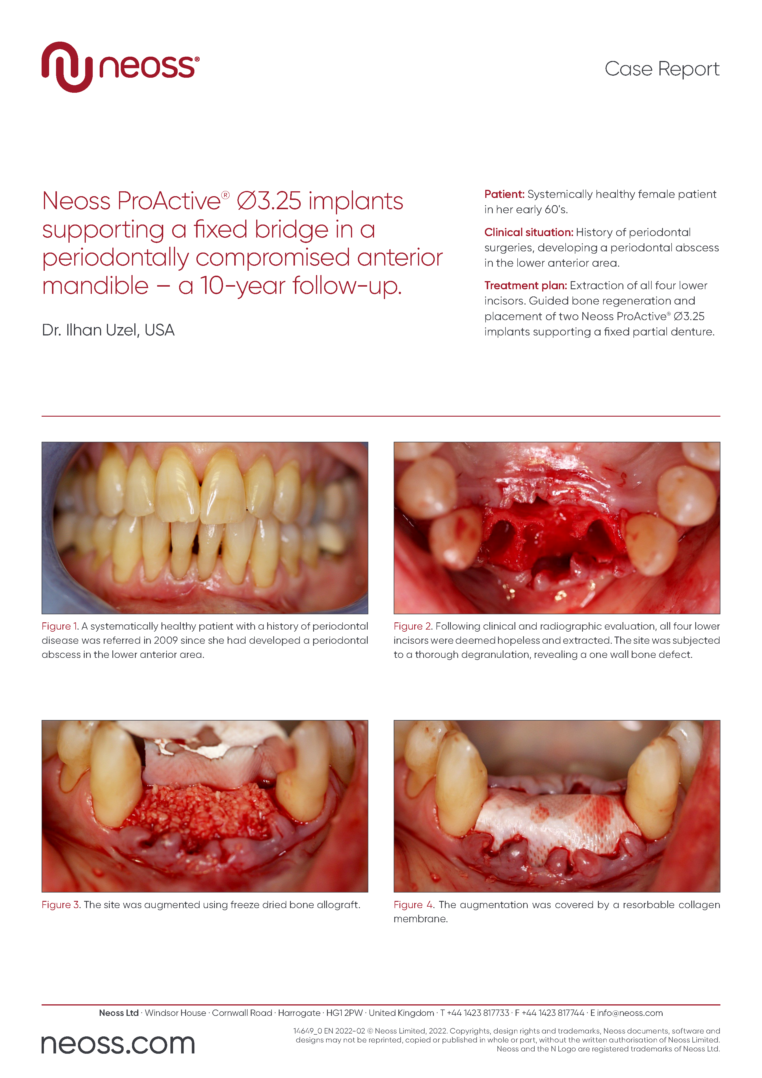 Case Report: Neoss ProActive® ∅ 3.25 implants supporting a fixed bridge, Dr. Ilhan Uzel, USA
