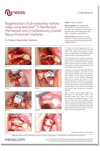 NeoGen® - Regeneration of an extremely narrow ridge and simultaneously placed implants