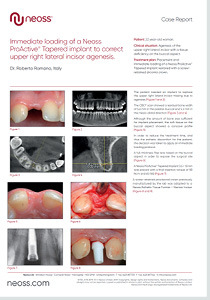 Immediate loading of a Neoss ProActive® Tapered implant to correct upper right lateral incisor agenesis.