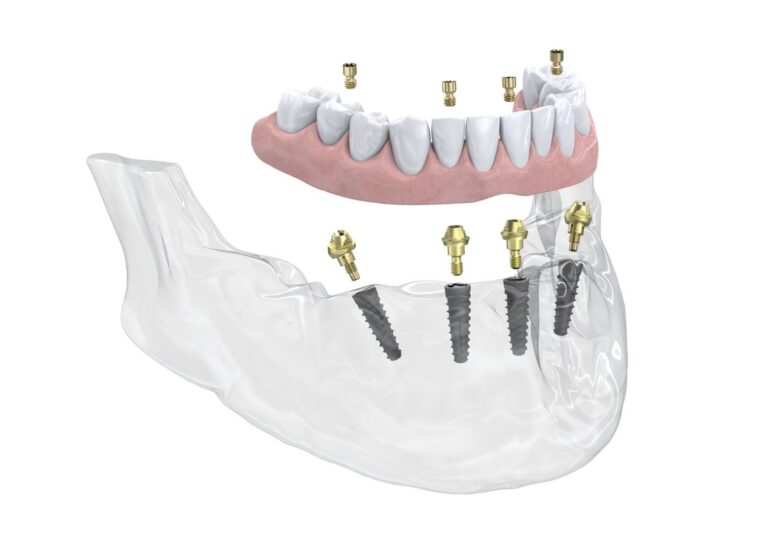 Neoss® lanciert ein neues Multi-Unit Abutment für Neoss4+ Behandlungslösungen